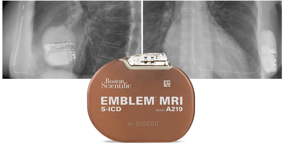 Emblem Mri S Icd System Implant Procedure Boston Scientific